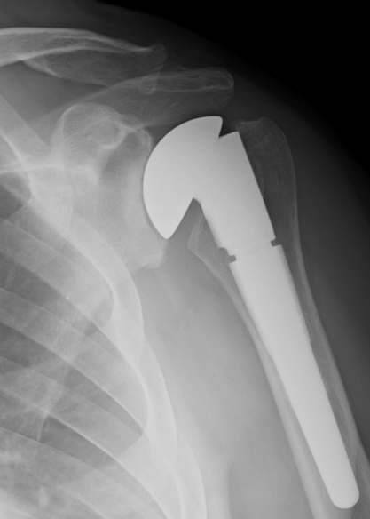 Shoulder Hemiarthroplasty for Osteoarthritis AP